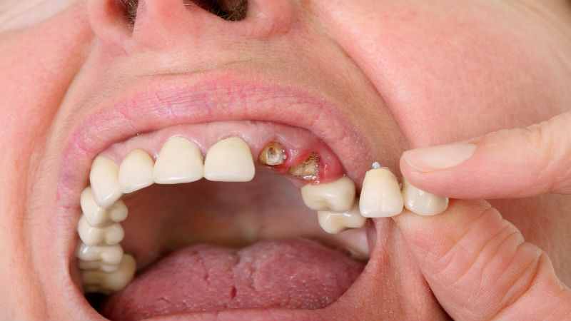 All of What is Involved in a Single Tooth Replacement in Nassau County NY