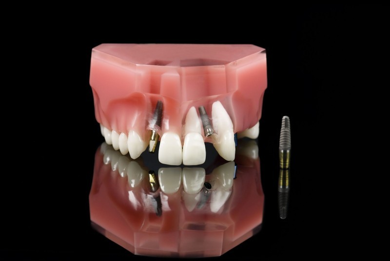 Advantages And Disadvantages Getting Of Dental Implants In Charleston SC