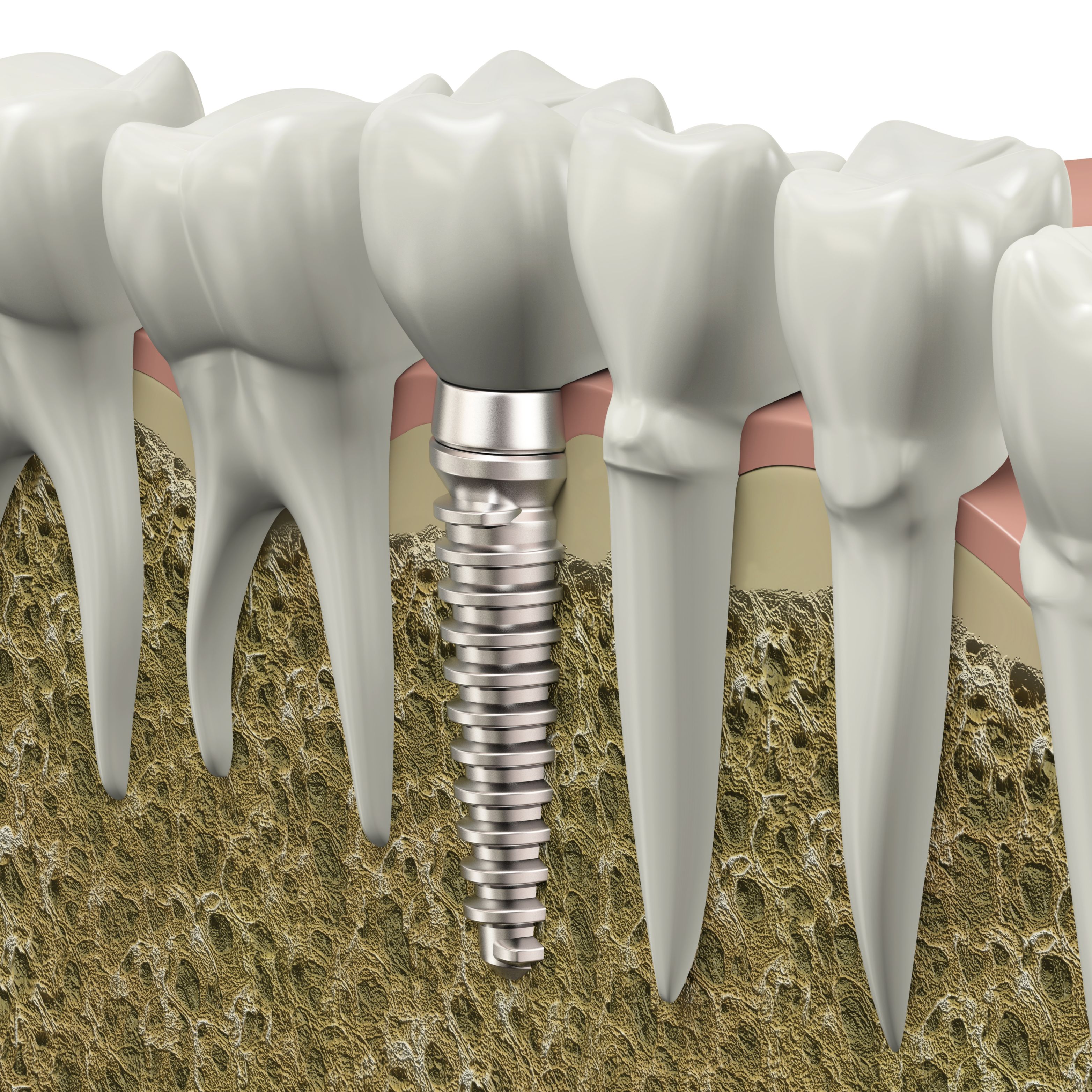 Natural Looking Porcelain Crowns in Henderson