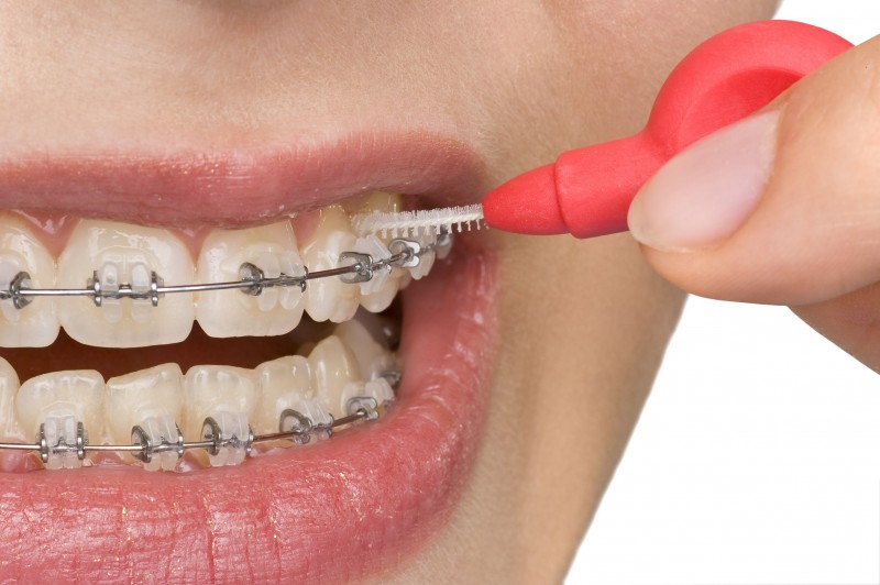 Learning More About Orthodontic Treatment In Bernardsville, NJ