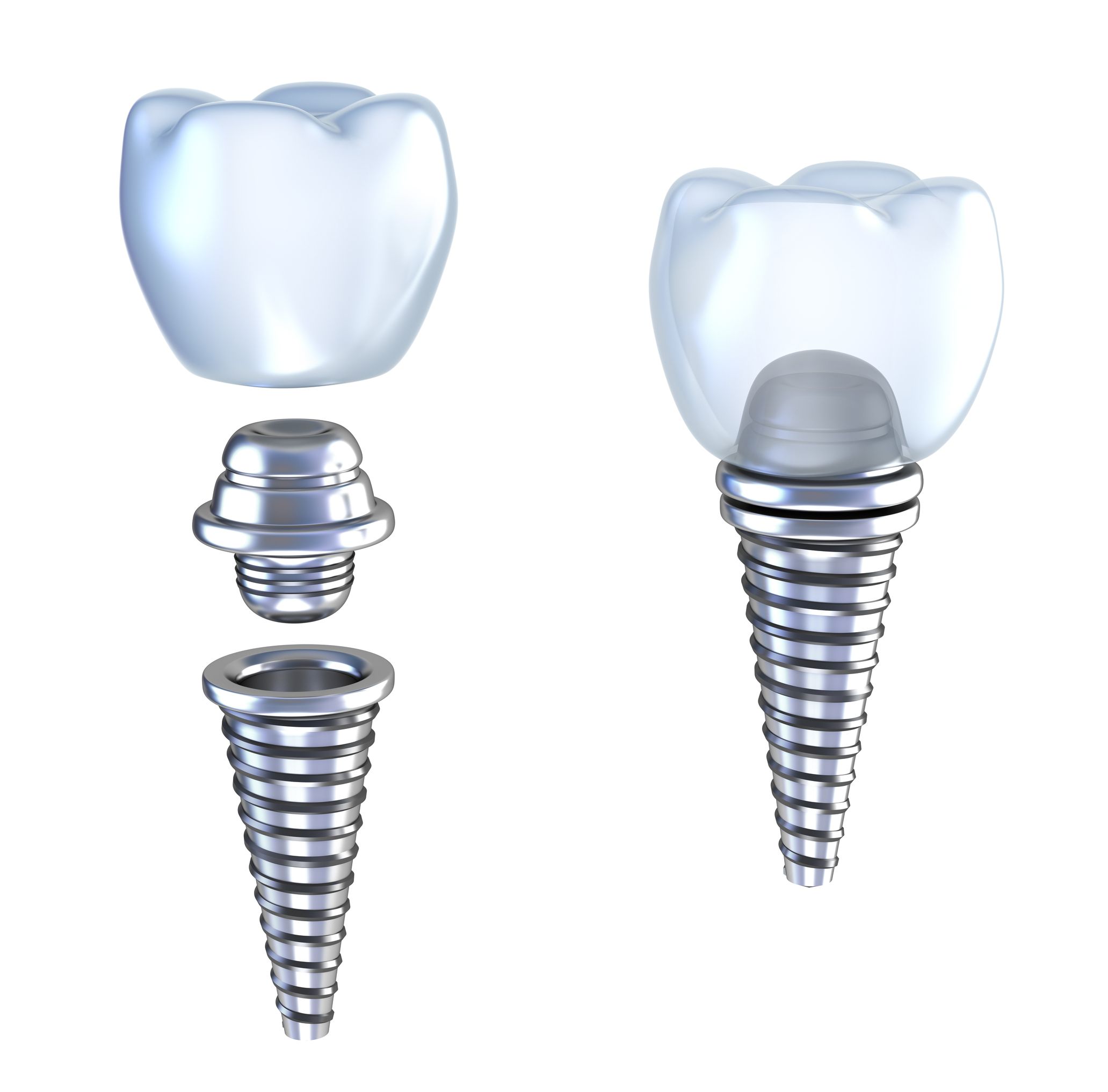 Dental Implants In Hill District: Benefits
