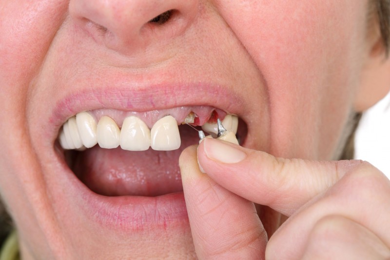 The Importance of Ongoing Proper Care for Teeth Implants in Cranford, NJ