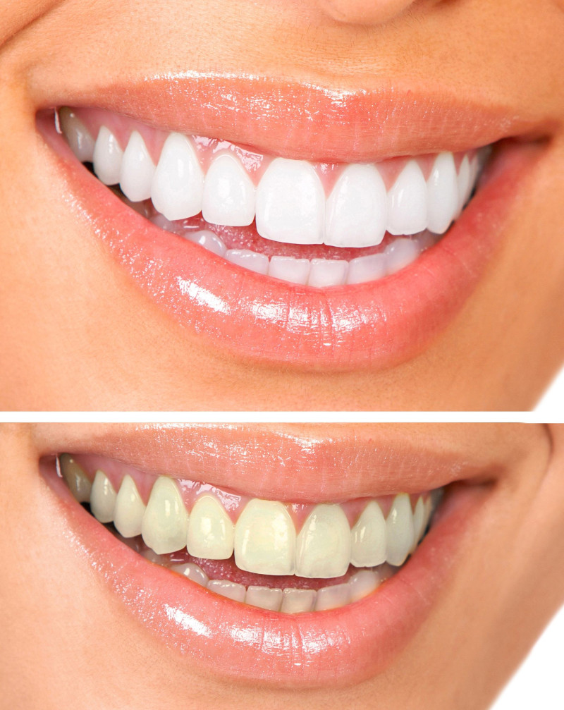 Benefits Offered by Teeth Cleaning in Wildwood MO