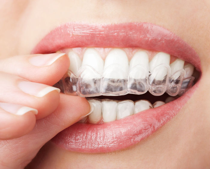 How an Orthodontist in Chanhassen, MN Can Help Teens Achieve a Confident Smile Faster